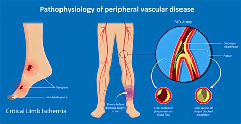 Peripheral Vascular Disease Pvd 中文 Hannoke