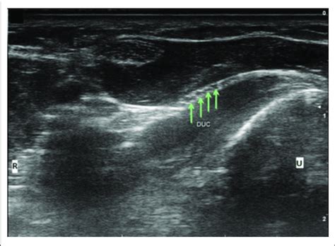 Dorsal Ulnar Cutaneous Nerve Duc Fascicles Flattening As It Courses