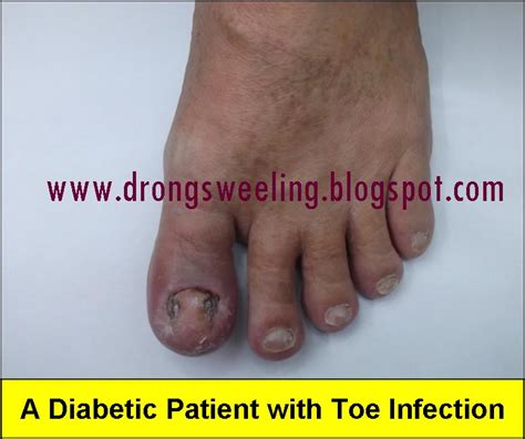 Tcm News Tcm Physician Treat A Diabetic Patient With Toe Infection