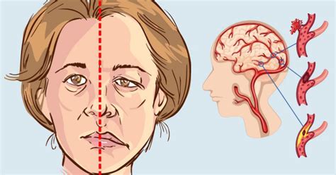 Signs Of A Stroke Women Should Never Ignore Healthy Source