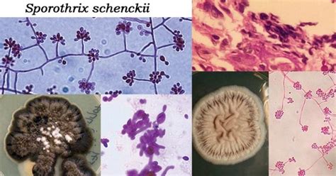 Sporothrix Schenckii An Overview