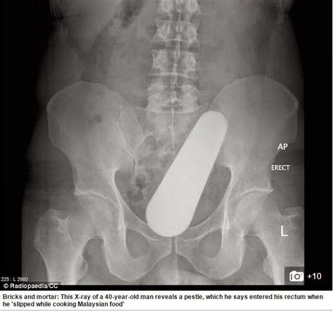 Photos Xrays Of The Strangest Things Found Stuck In Patients Rectums