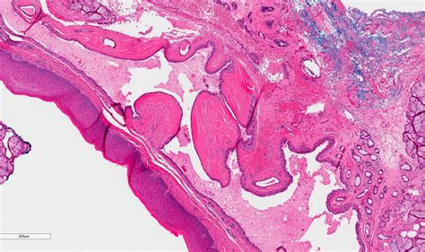 Pathology Outlines Salivary Duct Cyst