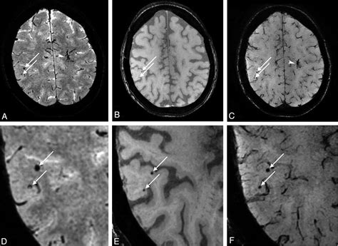 Cerebral Microbleeds On Mr Imaging Comparison Between 15 And 7t