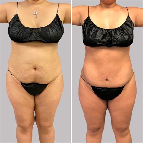 Liposuction Before And After Photos What You Can Really Expect Say
