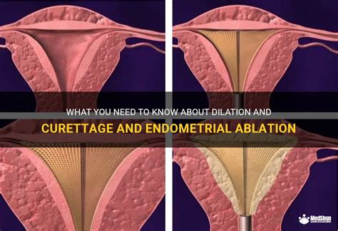 What You Need To Know About Dilation And Curettage And Endometrial