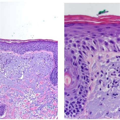 Skin Biopsy Low And High Power Demonstrating Early Epidermal