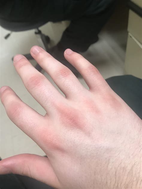 Beginning Of Dermatomyositis Rash Noticed It On Both Hands A Month