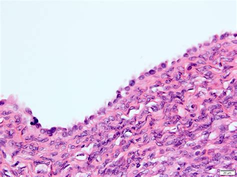 Pathology Outlines Adult Cystic Nephroma