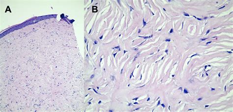 Fibroepithelial Polyp Skin Fibroma A Histological Skin Sections