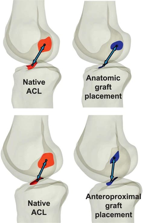 Effects Of Acl Graft Placement On In Vivo Knee Function And Cartilage Thickness Distributions
