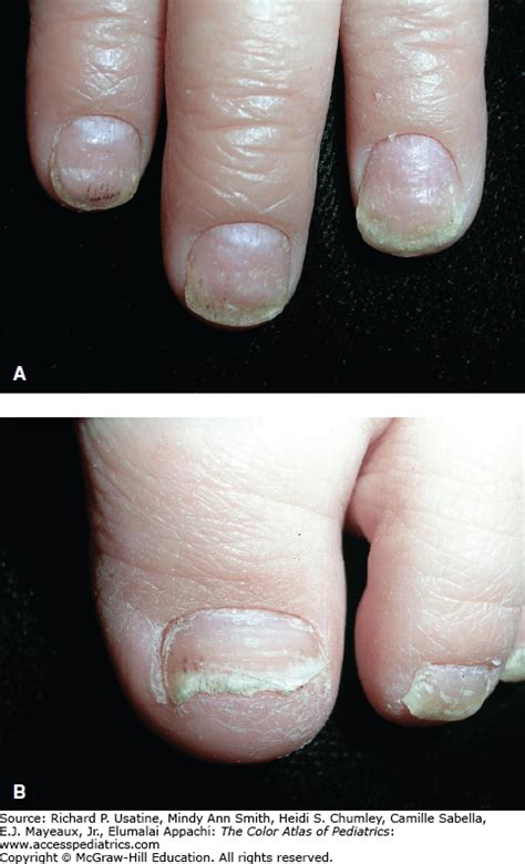 Psoriatic Nails Obgyn Key