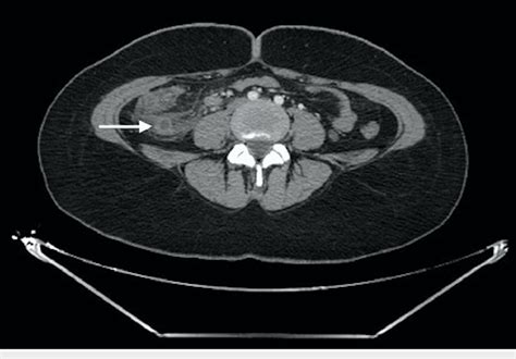 Axial Ct Scan Showing Swollen Appendix Surrounded By Mesenteric Fat