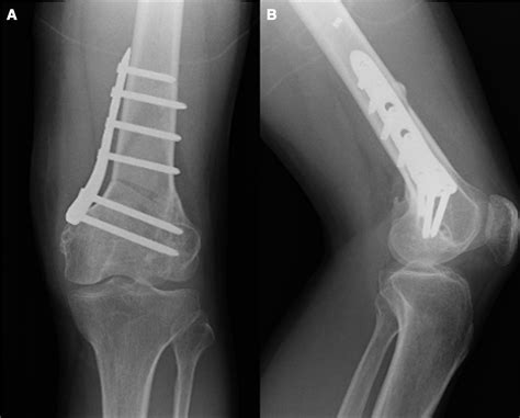 Distal Femoral Osteotomy For Genu Valgum Deformity Caused By Malunited