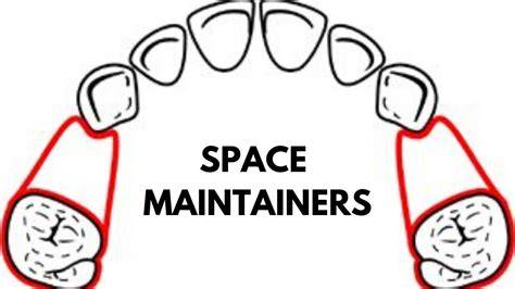 Space Maintainers In Orthodontics Youtube
