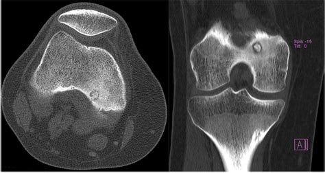 Medicina Free Full Text Osteoid Osteoma Treatment With Microwave