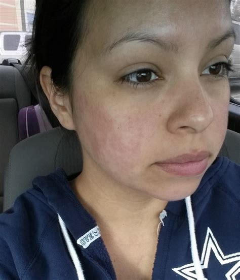 Butterfly Rash On Face Baby