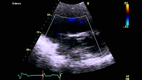 Ebsteins Anomaly Transthoracic Echocardiogram Tte Echocardiogram