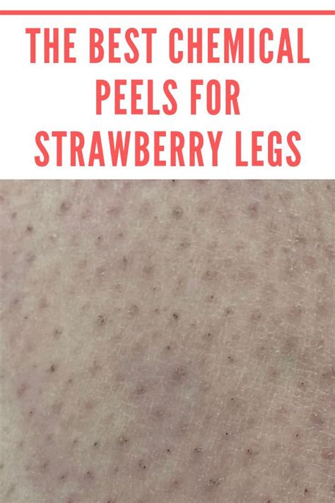 Do You Want To Get Rid Of The Large Dark Pores On Your Legs If You