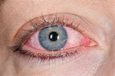 Episcleritis Stock Image C0370938 Science Photo Library