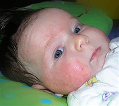 Baby Atopic Dermatitis Eczema Free Skin