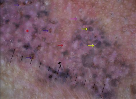 Dermoscopic Features Of Basal Cell Carcinoma In Skin Of Color A
