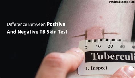 Difference Between Positive And Negative Tb Skin Test