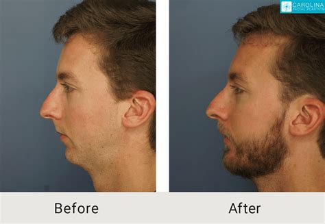 Chin Implant And Multi Level Fat Grafting To Jawline Carolina Facial