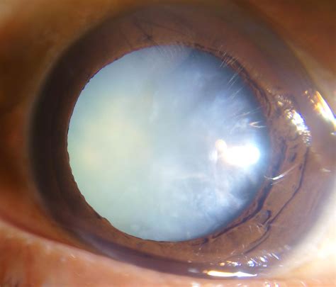 Cataract Eyewiki