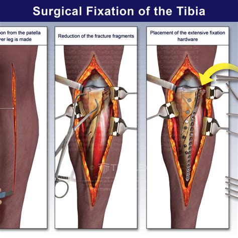 Surgical Fixation Of The Tibia Trialexhibits Inc