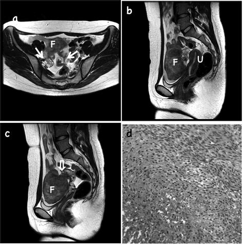 pelvic tumors with normal appearing shapes of ovaries and uterus presenting as an emergency review