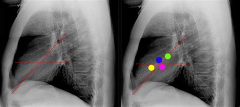 Ateral Chest Radiograph A Second Line Is Drawn Which Bisects The