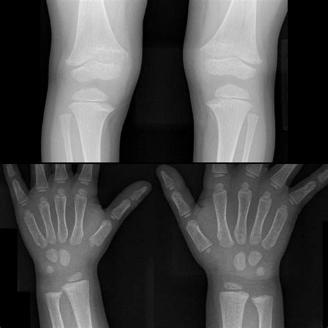 Hereditary Hypophosphatemic Rickets Pediatric Radiology Reference