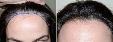 Hair Transplants For Women Before And After Photos Foundation For Hair Restoration