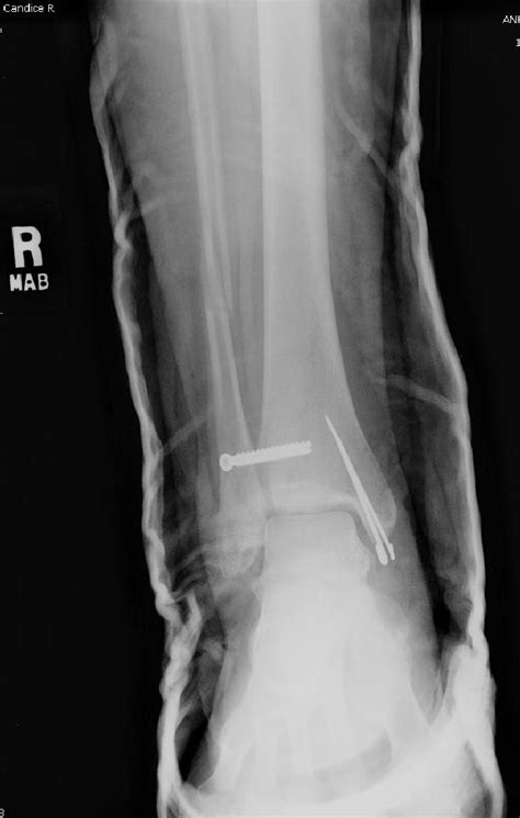Figure 3 From Early Ambulatory Treatment Of Ankle Fractures Utilizing