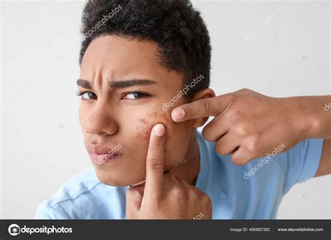 African American Teenage Boy Acne Problem Light Background Stock Photo