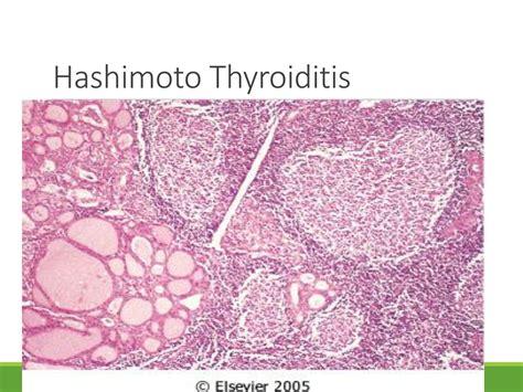 Ppt Hypo Hyperthyroidism And Hashimotos Thyroiditis Powerpoint