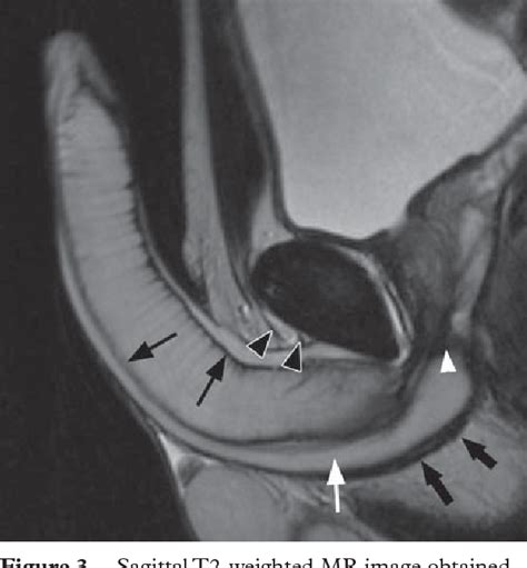 Figure From Mr Imaging Of Nonmalignant Penile Lesions Semantic Scholar