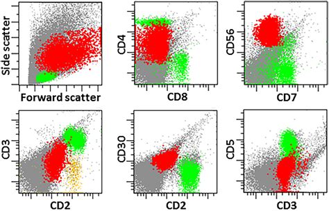 Flow Cytometry Applications In The Diagnosis Of Tnk‐cell