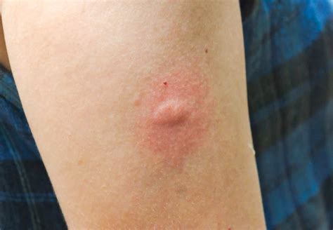 Mosquito Bites On Humans Nextgen Pest Solutions