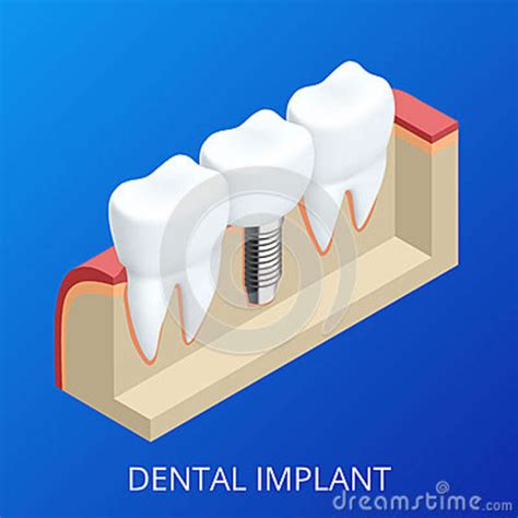Implante Humano Del Diente Isométrico Concepto Dental Dientes O