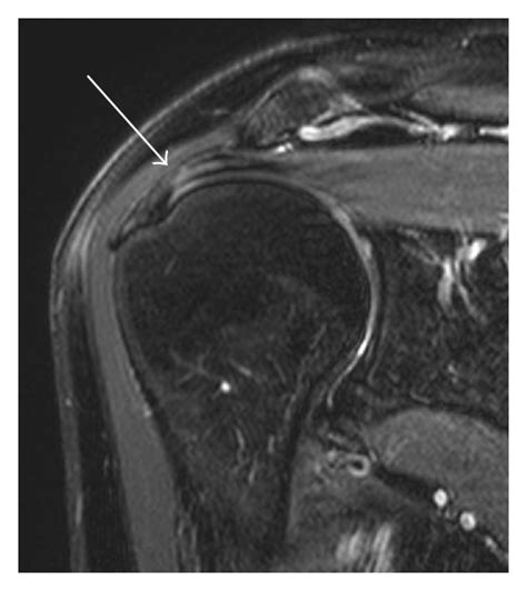 Correlation Between Rotator Cuff Tears And Systemic Atherosclerotic Disease