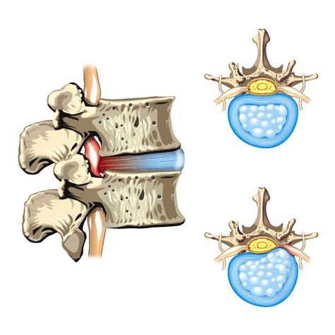 Recovering From A Lumbar Disc Injury
