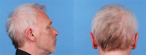 Sudden Onset Hair Loss And Colour Change The Bmj