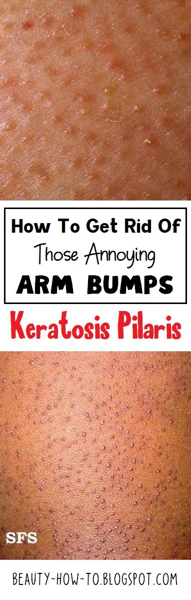 How To Get Rid Of Those Annoying Arm Bumps Keratosis Pilaris How To