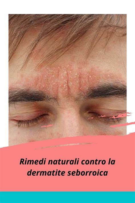 Rimedi Naturali Contro La Dermatite Seborroica Artofit