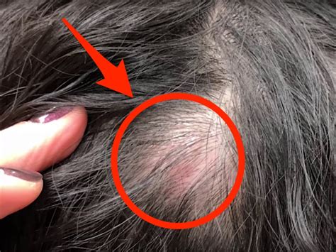 Dr Pimple Popper Removes A Pilar Cyst From A Woman S Head