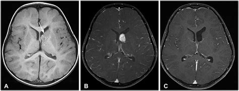 The Clinical Characteristics Of Subependymal Giant Cell Astrocytoma