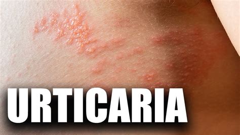 Urticaria Cauze I Tratament Youtube