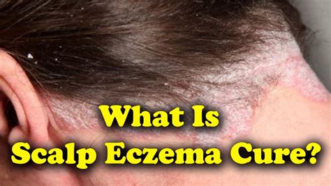What Is Scalp Eczema Cure Symptoms And Treatments Youtube